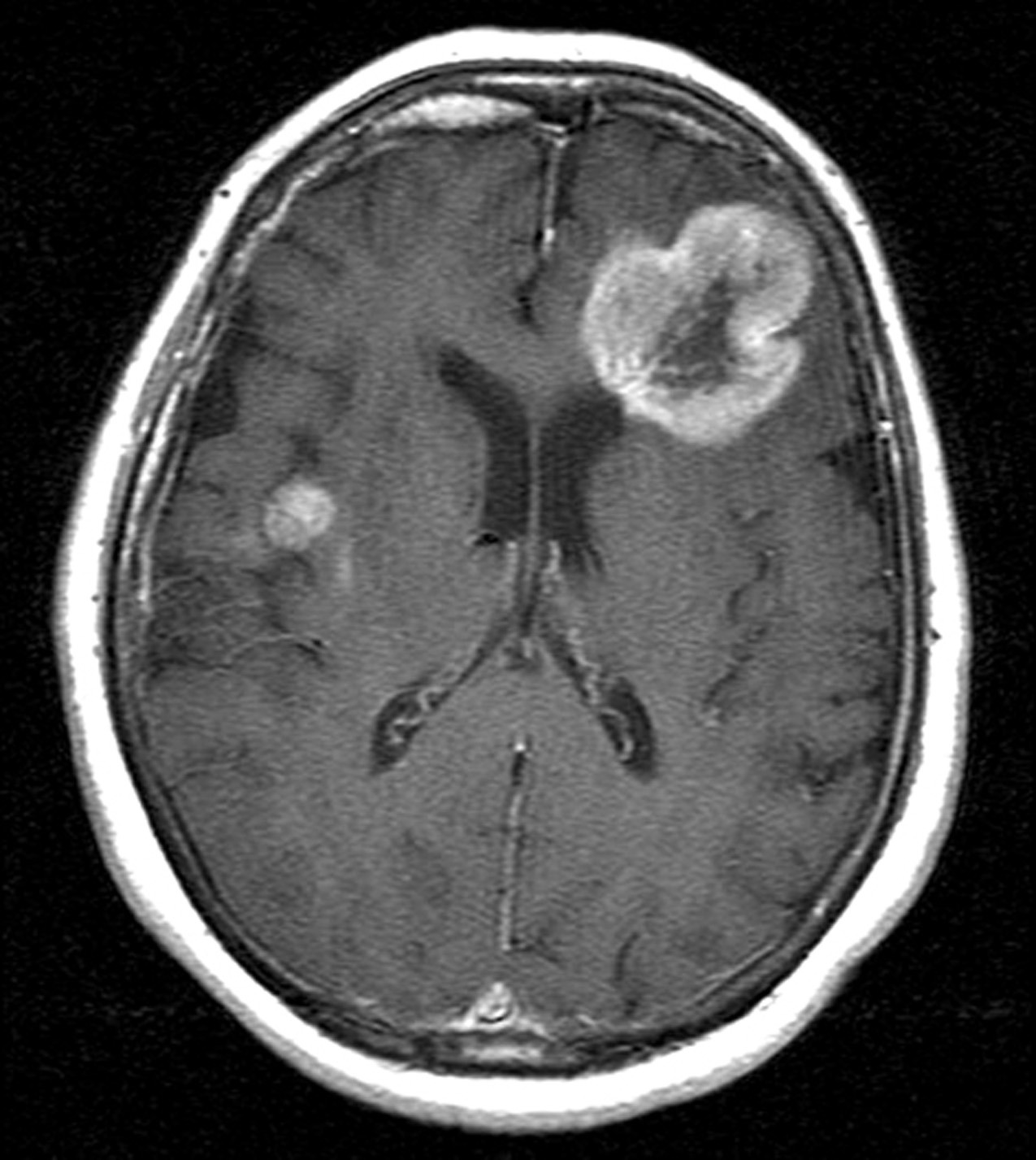 Skripsi untuk Deteksi Tumor Otak